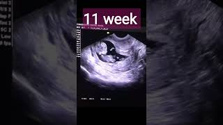 Pregnancy 10 18 weeks baby on Ultrasound [upl. by Whitver480]