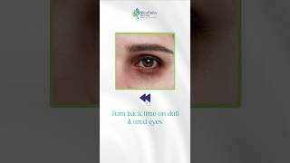 Best Treatment For Dark Circles Full Eyes darkcircles undereyedarkcircle [upl. by Oiramal]