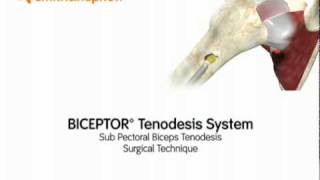 Intro Sub Pectoral Biceps Tenodesis  Simon Moyes Capital Orthopaedics [upl. by Aynam397]