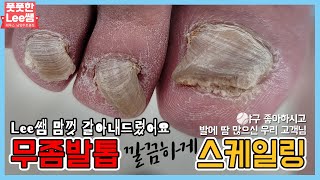 ENG SUB무좀발톱 깔끔하게 스케일링 해드렸어요 개운 tinea unguium  athletes foot  Fresh Foot 성수점  남양주호평점 [upl. by Leinahtan]