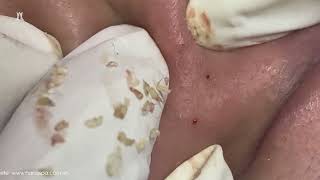 Big Cystic Acne Blackheads Extraction Blackheads amp Milia Whiteheads Removal Pimple Popping [upl. by Gussie]