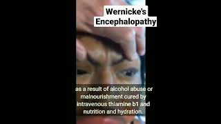 Wernickes Encephalopathy [upl. by Doowyah411]