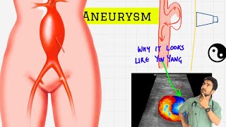 aneurysm 🌀🩸 [upl. by Malim]