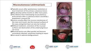 36Leishmaniasis Clinical Features Diagnosis and Management [upl. by Yelknirb279]