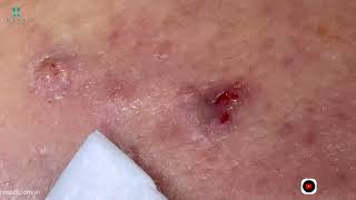 Big Cystic Acne Blackheads Extraction Blackheads amp Milia Whiteheads Removal Pimple Popping [upl. by Parke]