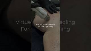 Virtue RF Microneedling For Skin Tightening [upl. by Byrle]