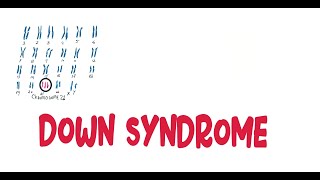 Trisomy 21Down Syndrome  sign and Symptoms Complications Diagnosis Management of Down syndrome [upl. by Hew]