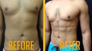 Vaser HiDef Liposuction Male BeforeAfter Video  Advanced Lipo Centre [upl. by Ahsek]