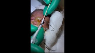 Retinopathy of Prematurity ROP Intravitreal Lucentis NICU [upl. by Yanahs]