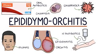 Understanding Epididymoorchitis [upl. by Annoynek]