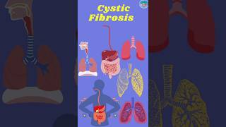 Cystic Fibrosis Mechanism Development Management and Treatment cysticfibrosis cystic [upl. by Nnasus]