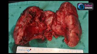 Thyroidectomy Huge Thyroid with compressive symptoms [upl. by Ceciley782]