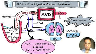 What is Post Ligation Cardiac Syndrome in Neonates [upl. by Naus]