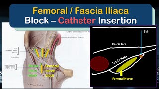 Femoral Nerve  Fascia Iliaca Block Catheter  A quotHowToquot Guide to Insertion [upl. by Ferris139]