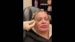 Nurse Heather Explain PRP Injections Under the Eye [upl. by Alan]