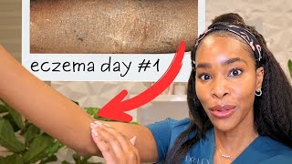 12 Life Changing Tips For Eczema From a Derm with Eczema [upl. by Aryad]