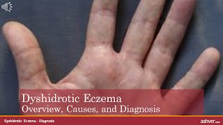 Dyshidrotic Eczema  Overview Causes and Diagnosis [upl. by Mccullough]