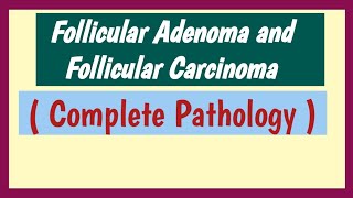 Follicular Adenoma And Follicular Carcinoma  Thyroid Neoplasm [upl. by Teresa]