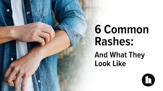 6 Common Rashes And What They Look Like  Healthline [upl. by Ajani761]