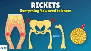 Rickets – Causes Signs and Symptoms Diagnosis amp Treatment [upl. by Lally]