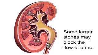 How Kidney Stones Are Formed Animation  Renal Calculi Causes amp Symptoms Video  Blocked Urine Flow [upl. by Gaby]