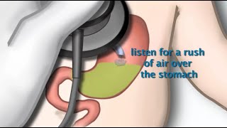 Nasogastric Tube Placement by S Hamilton  OPENPediatrics [upl. by Lynett]