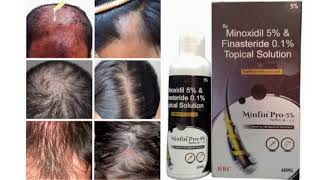 Minfin Pro 5 Topical Solution Minoxidil 5 amp Finasteride 01 Topical Solution [upl. by Auod]