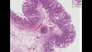 Histopathology ColonHyperplastic polyp [upl. by Neelrac]