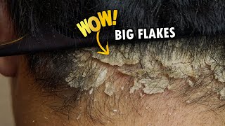 Scratching Psoriasis Big Flakes Back Of Head Dandruff Removal Satisfying 357 [upl. by Ecargyram]