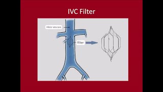 Management of DVTPulmonary Embolus [upl. by Etiam]