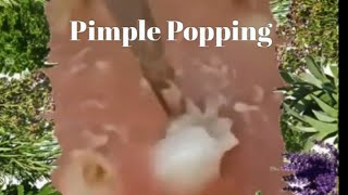 Popping Pimples and Blackheads  3 [upl. by Annai739]