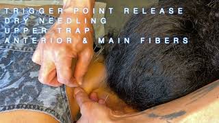 Trigger Point Release  Dry Needling Upper Trap anterior amp main fibers [upl. by Yelekreb]