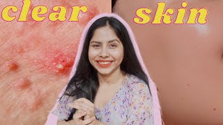 How I Cleared My Skin 3 Products that are Amazing for Breakouts amp PigmentationsClear Skin Routine [upl. by Bena]