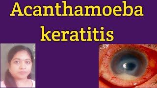 Acanthamoeba keratitis Life cycle of AcanthamoebaRadial perneuritisInvestigationsTreatment PHMB [upl. by Undine]