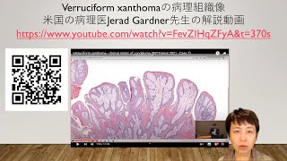 verruciform xanthomaの病理組織像 [upl. by Eilra]