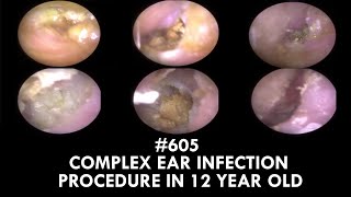 605  Complex Ear Infection Procedure in 12 Year Old [upl. by Bently]