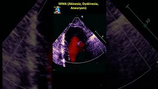 WMA Akinesia Dyskinesia Aneurysm [upl. by Rudiger]