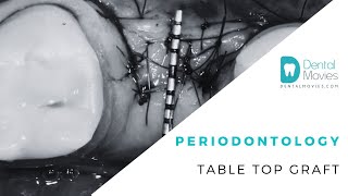 Periodontology  table top graft [upl. by Pearla438]