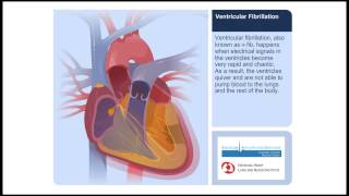 Ventricular Fibrillation Animation Video [upl. by Hynes]