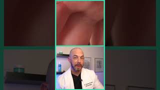 Derm reacts to huge splinter removal dermreacts doctorreacts splinterremoval [upl. by Ahsilef]