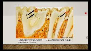 ZU Dental Cariology Histopathology of dental caries  3 [upl. by Aiciled]