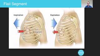 Flail Segment  Australian Paramedical College [upl. by Tavy361]