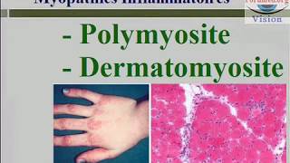 Les Myopathies inflammatoires  Polymyosite et Dermatomyosite Faiblesse musculaire [upl. by Keil632]