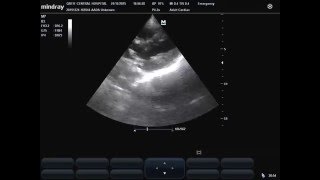 subcostal view of Kissing Heart in septic shock in patient with COPD [upl. by Atinram]