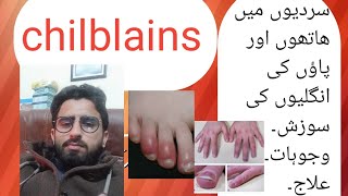 who to treat swollen fingers chilblains ibrarhussain4349 انگلیوں کی سوزش [upl. by Talbott]