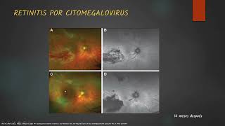 Coriorretinitis Infecciosas [upl. by Matheny]