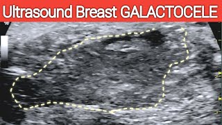 Ultrasound BREAST GALACTOCELE  A Lactating Breast  Complicated Milk Cyst [upl. by Eissirk23]