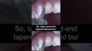 Prepping ANTERIOR Teeth with Enamel Hypoplasia  Ep 2 dentalshorts [upl. by Waylen]