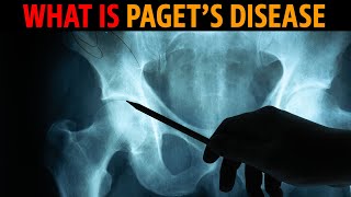 What is Pagets disease [upl. by Delacourt690]