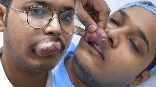 Man with a Large Hemangioma in his Upper Lips  Complete Before amp After Case Study [upl. by Stanleigh235]